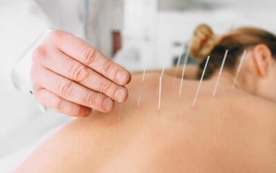 Acupuncture for Immune Health: How It Helps